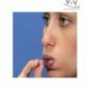 Placa Oral PROFONO ® 