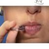 Placa Oral PROFONO ® 